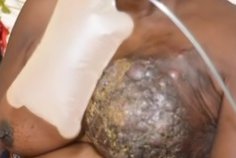 Cancer du sein :  une femme en détresse lutte pour sa survie à Port-Gentil